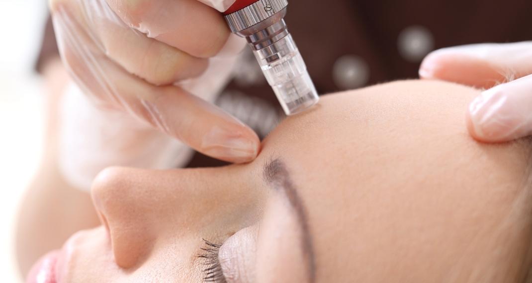 Microneedling/Photo:Shutterstock